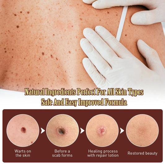Mole & Wart Remover Cream🤩–Fast & Effective Skin Solution